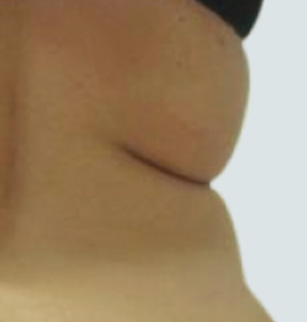 endosphere-trattamenti_corpo_2_prima