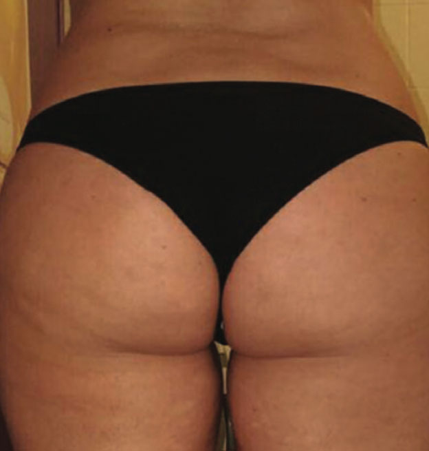 endosphere-trattamenti_corpo_5_dopo