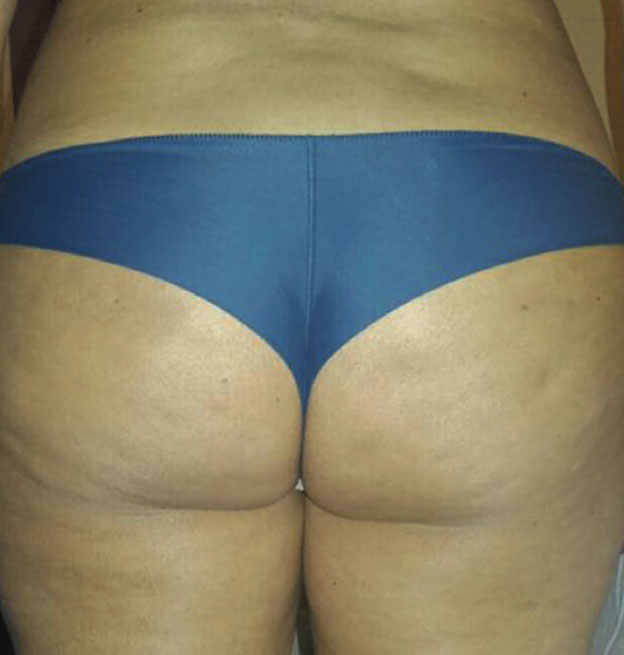 endosphere-trattamenti_corpo_5_prima
